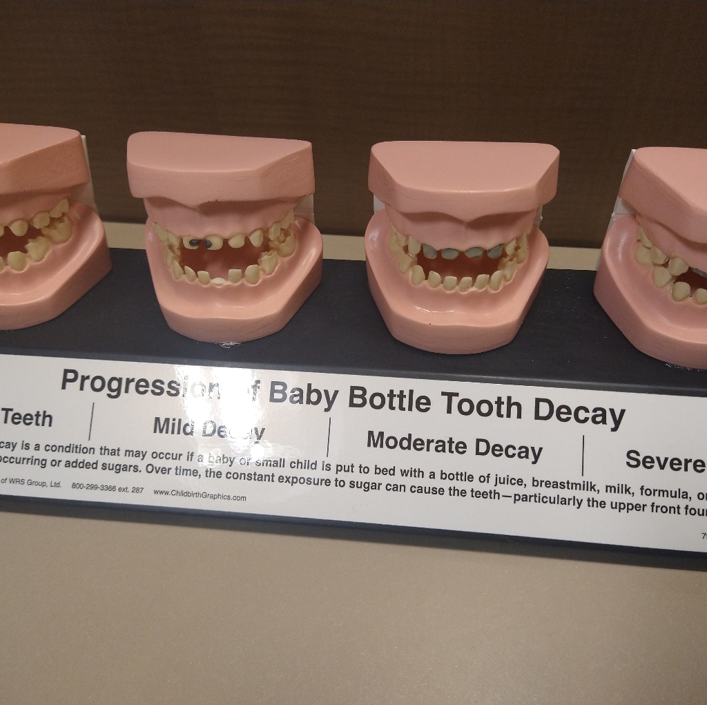 Tooth Decay Model
